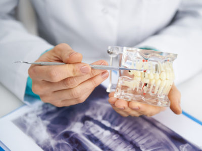 dental implant surgery