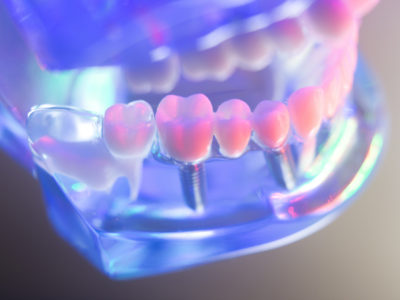 How much does dental implants cost