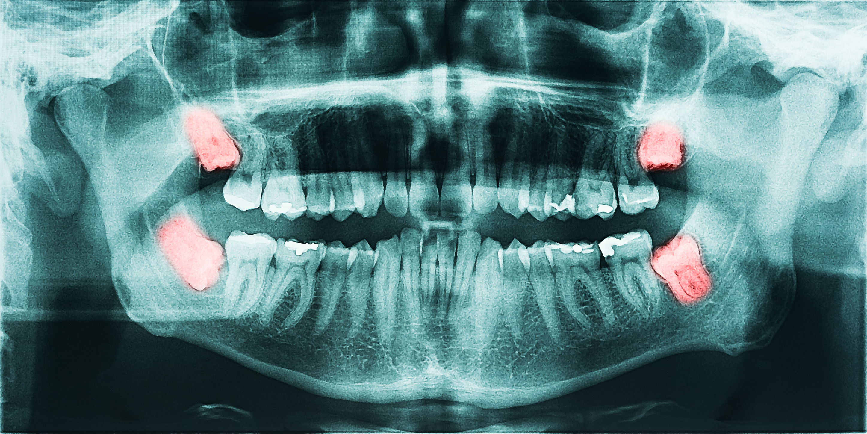 why-do-i-have-to-get-my-wisdom-teeth-removed-dansville-dental