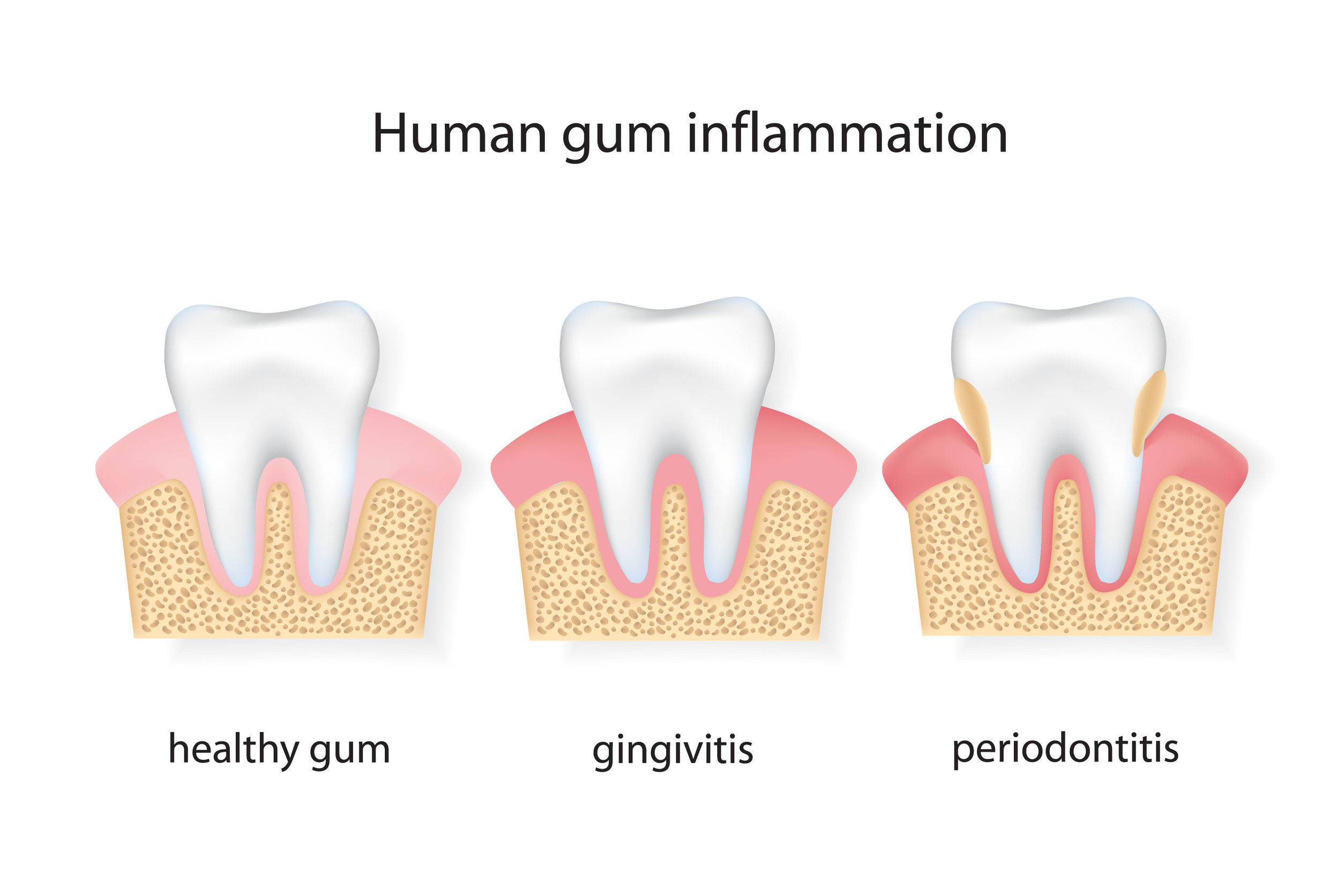 teeth cleaning for healthy gums