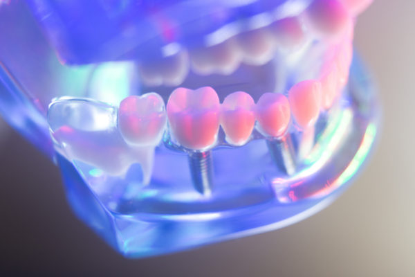 How much does dental implants cost