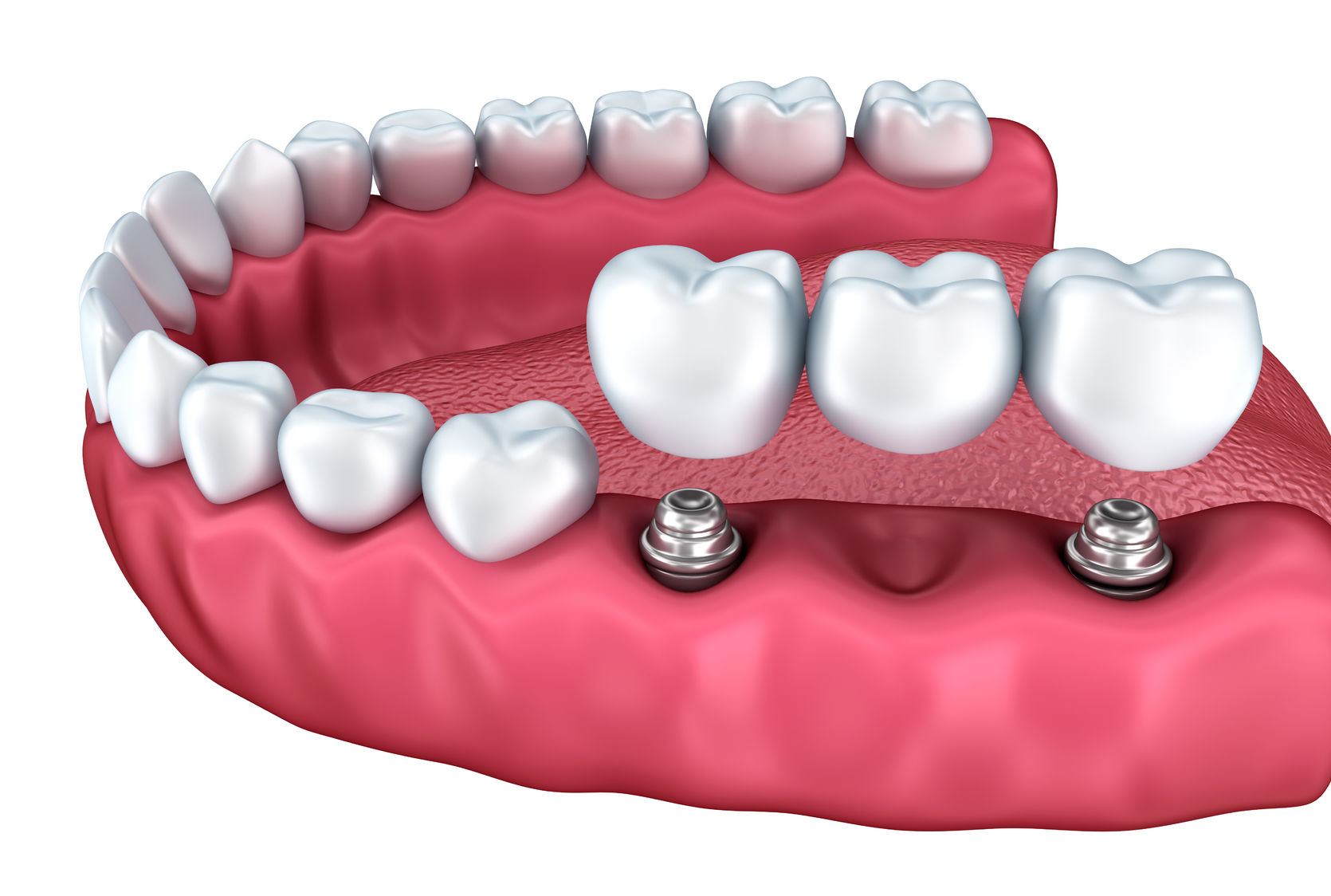 Dental Implant Options for Multiple Missing Teeth - Dansville Dental  Professionals