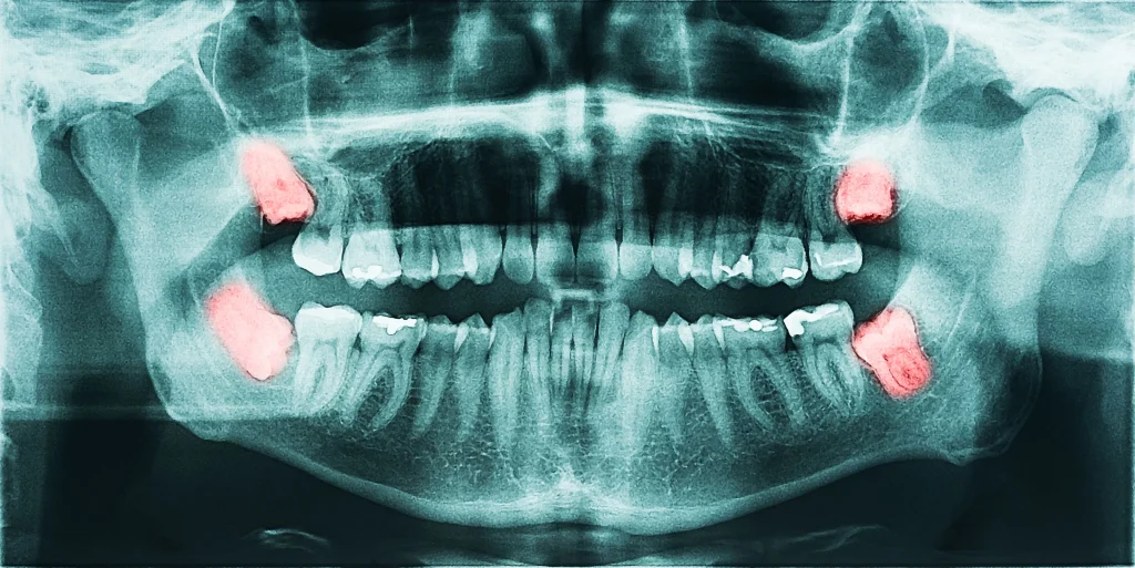 An x-ray image of wisdom teeth